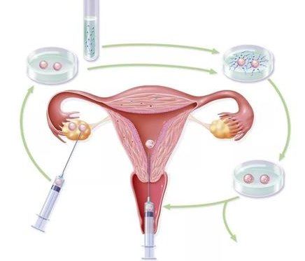 试管移植前塞万艾可的作用与功效，增厚子宫内膜是其一